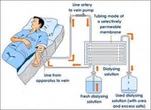 Treatment Kidney Failure